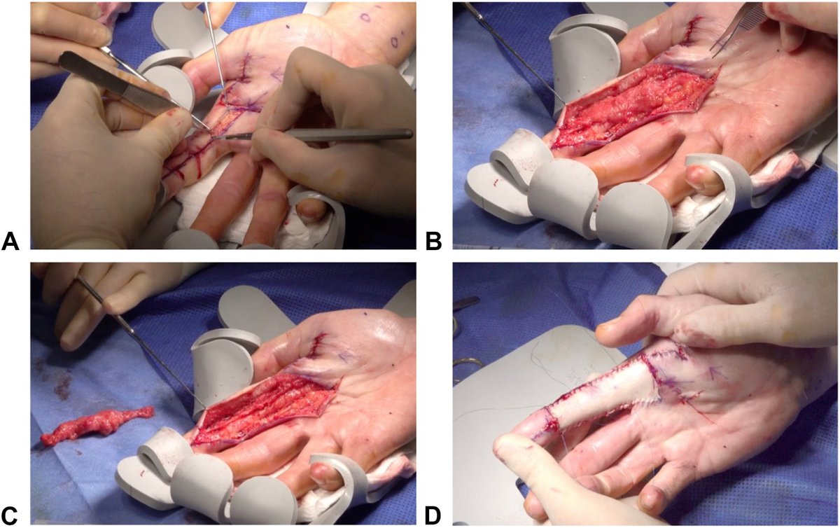 J Hand Surg Am- ASSH tweet media