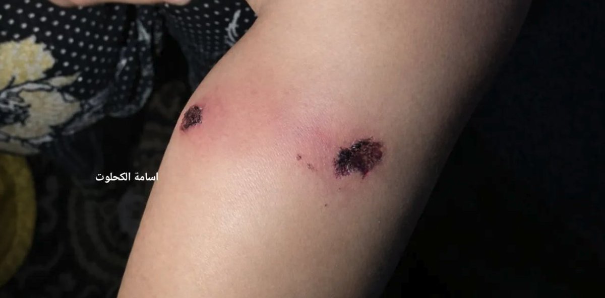 Israeli troops tortured Karim in front of his father, Osama Abu Nassar, including burning his leg with cigarettes, local media say.

Karim was freed after 10 hours via Red Cross, his wounds noted in a medical report. Nassar remains in Israeli custody
🔗trt.world/c17p