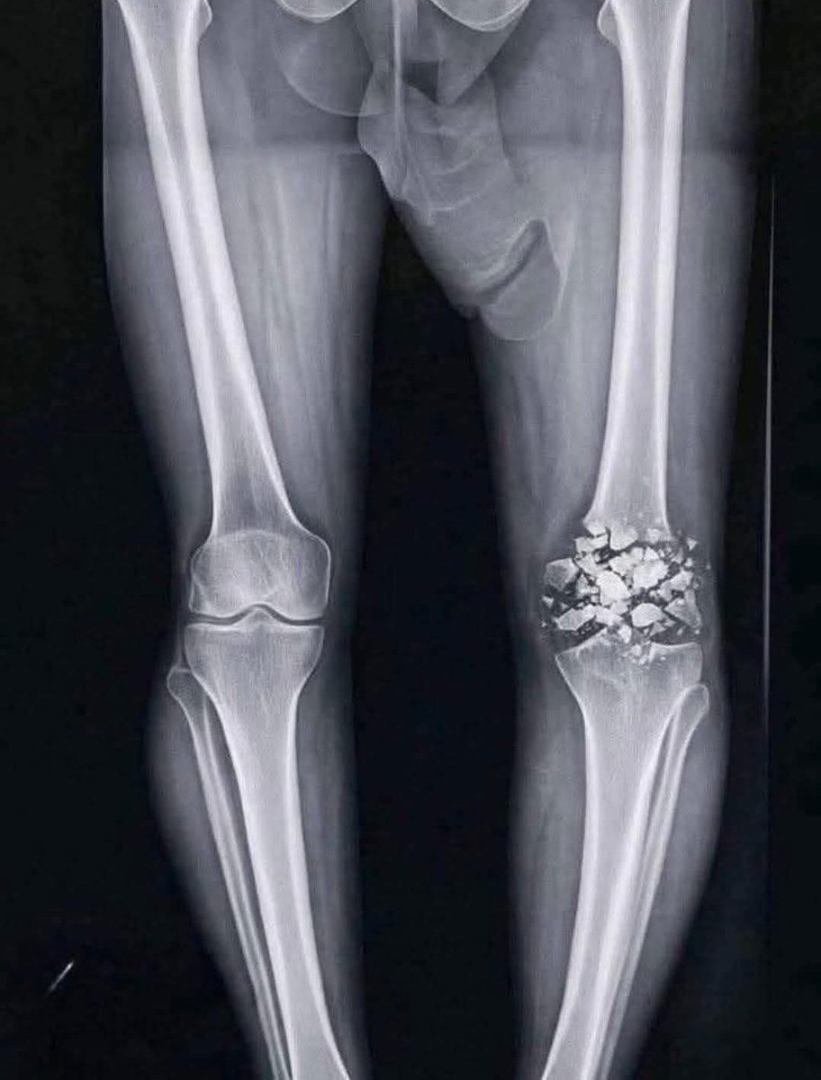 me rebentado la rodilla jajajjajjaj