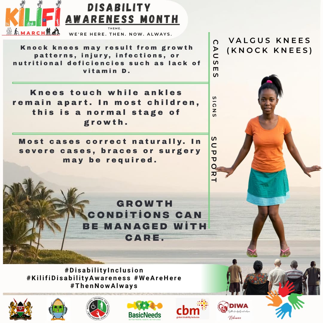 _Roda_Nzawa_'s tweet photo. Did you know that Knock knees may result from growth patterns, injury, infections, or nutritional deficiencies such as lack of Vitamin D.
#DisabilityInclusion #KilifiDisabilityAwareness #WeReHere #ThenNowAlways https://t.co/SI9haKlO5A