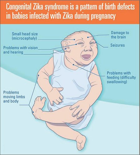osemagnum's tweet photo. A SIMPLE MOSQUITO BITE IN SOME REGIONS CAN BE VERY DEVASTATING TO THE BABY

MOSQUITOES KILL, KILL MOSQUITOES

Zika virus is transmitted mainly through the bite of an infected Aedes mosquito, the same familiar, almost forgettable mosquito that thrives in warm climates and bites mostly during the day. And yet, in pregnancy, this small encounter can carry profound consequences. Many adults infected with Zika have mild symptoms, or none at all, which makes it easy to miss.

The concern in pregnancy is that the virus can cross the placenta and infect the developing fetus. And because the fetal brain is still forming, the virus has a particular affinity for neural tissue, it disrupts growth, interferes with cell development, and in some cases, leads to a condition called Microcephaly, where the baby’s head is significantly smaller than expected due to impaired brain development.

And so, a simple mosquito bite becomes something more, it becomes a quiet interruption in the story of growth. Babies affected may face developmental delays, seizures, vision or hearing problems, depending on the severity of the infection.

Prevention, therefore, becomes our strongest voice, avoiding mosquito bites, using repellents safe in pregnancy, wearing protective clothing, and being cautious when travelling to high-risk areas. Because sometimes, in medicine, it is the smallest things, a virus you cannot see, carried by a mosquito you barely notice, that leave the deepest imprint.
