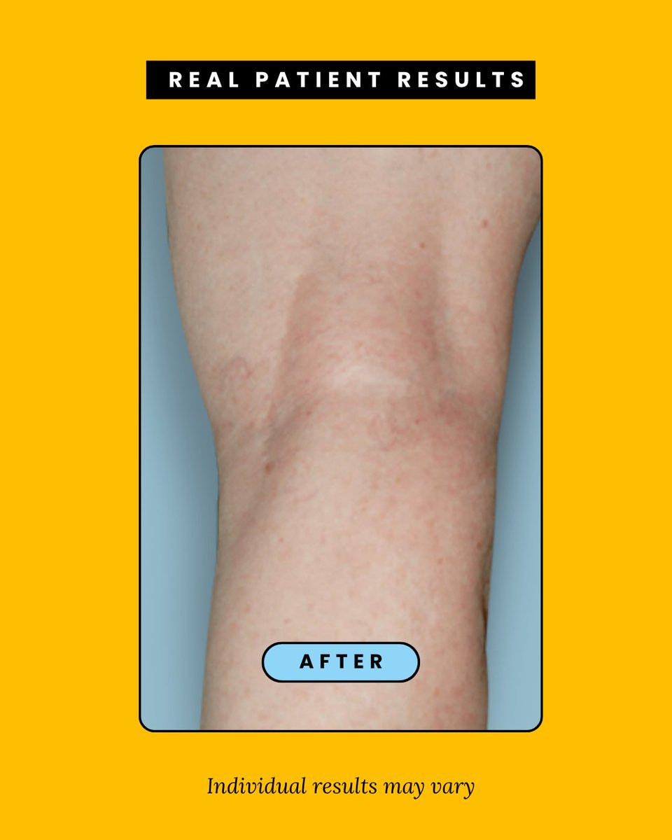 metrovein's tweet photo. When you turn discomfort into relief, you’re free to feel like yourself again. Take the first step by booking a vein evaluation. 
.
.
.
#varicoseveins #spiderveins #veins #veinhealth #veintreatment #veinspecialists #veindisease #beforeandafter https://t.co/8CkXx2fCFV
