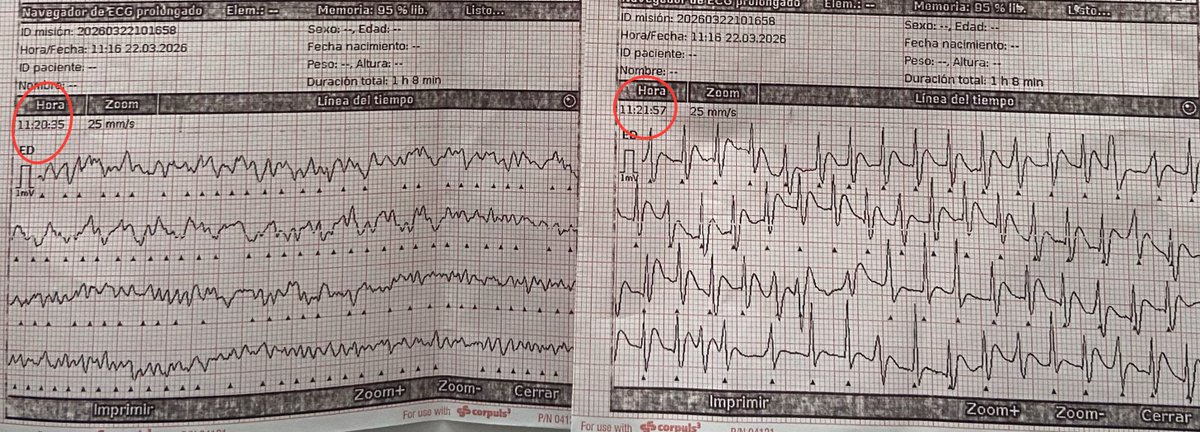 nicosojo's tweet photo. Cuando una RCP sale bien parece magia.

Pero no lo es.
Es un sistema que funciona: activación precoz, RCP telefónica, manos del alertante que no dudan, respuesta inmediata, 4 minutos en el lugar y desfibrilación temprana.

Detrás hay ciencia.
Y horas invisibles de entrenamiento. https://t.co/2GmpXpXei7