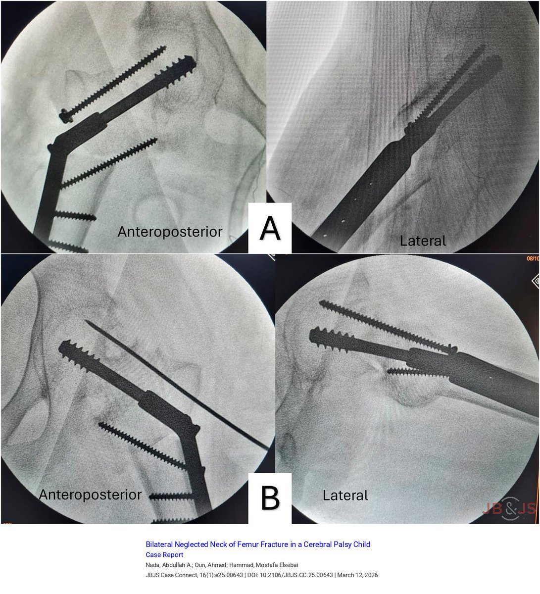 jbjs's tweet image. "Bilateral Neglected Neck of Femur Fracture in a Cerebral Palsy Child: Case Report" by Nada et al. 

Read the full article👉bit.ly/3NWHOt5

#pediatrics #hip #trauma