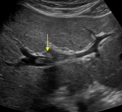 A case of Portal vein thrombosis: Ultrasound👌

Portal vein thrombosis is the most common cause of prehepatic portal hypertension, classically defined as partial or complete obstruction of the portal vein lumen.

Portal vein thrombosis is often asymptomatic and is discovered as