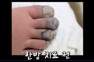 salmangsin's tweet photo. 내가 한의원 믿게 된 거.. 
동상으로 발 썩은 분이 절단수술 해야 한다고 했는데
한의원 가서 고친 썰 보고...
그후로 아픈 곳 생기면 한의원만 감... https://t.co/lhrV9m1NRn