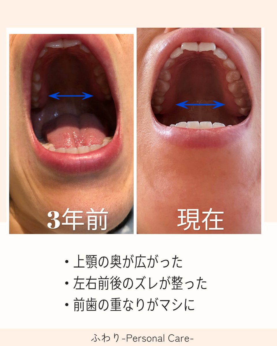 39歳、3年で 上あごの形が変わりました。 原因は歯ではなく ストレートネックによる 体の使い方。 何をしたか?