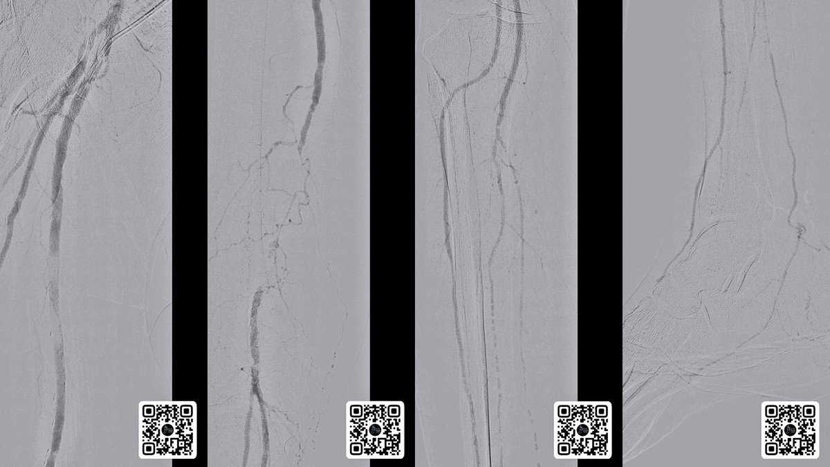 NikitoS888's tweet photo. Carboxyangiography-assisted angioplasty of lower extremity arteries in patients with chronic kidney disease and #CLTI #limbsalvagecenter @angiodroid https://t.co/IVBUwXzOMZ
