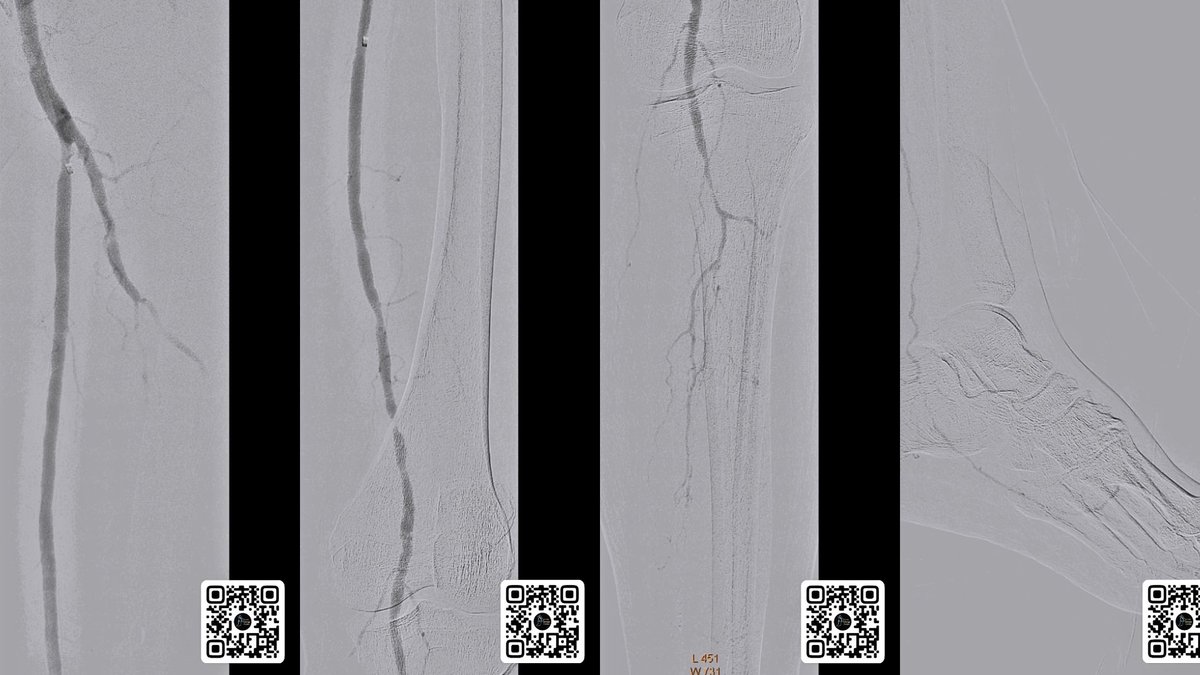 NikitoS888's tweet photo. Carboxyangiography-assisted angioplasty of lower extremity arteries in patients with chronic kidney disease and #CLTI #limbsalvagecenter @angiodroid https://t.co/IVBUwXzOMZ