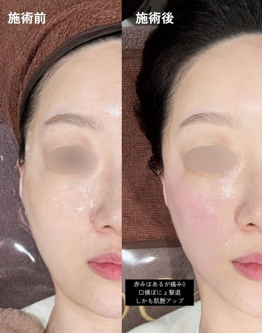 チューンライナーしようと思ってたけど韓国人は最近、絶対頬コケしないオールタイトしてるらしく勧められてやってみた！！
速攻性すごすぎ。インモードみたいなあざも、ウルセラみたいな腫れも痛みもなくてびっくり。しかもボセルの院長の打ち方うまいのか法令線まで消えた。値段やすいしこれはリピ確