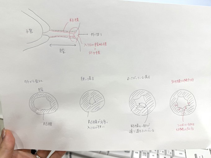 ゆき先生@婦人科形成 tweet media