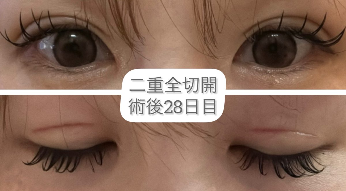 n17ph's tweet photo. 二重全切開DT28日目✨
あっという間に1ヶ月👀🪞
お友達にぱっちりした！と言われたけど自分から言うまで気づかれなかった😳🧡
お友達も羨ましがってた🤣💞 https://t.co/cUpTDydyey