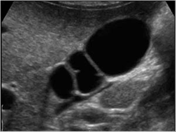 A case of Multiseptate Gallbladder: Ultrasound

These ultrasound images demonstrates a multiseptate gallbladder in the upper panel compared with a normal gallbladder in the lower panel.

A multiseptate gallbladder is a rare congenital anomaly characterized by multiple internal