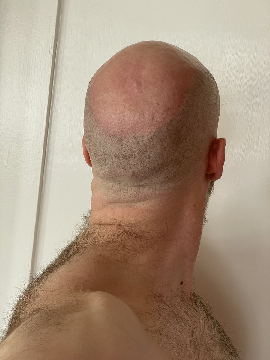 gobalddotme's tweet image. ⚡️⚡️⚡️

#laserhairremoval #malepatternbaldbychoice