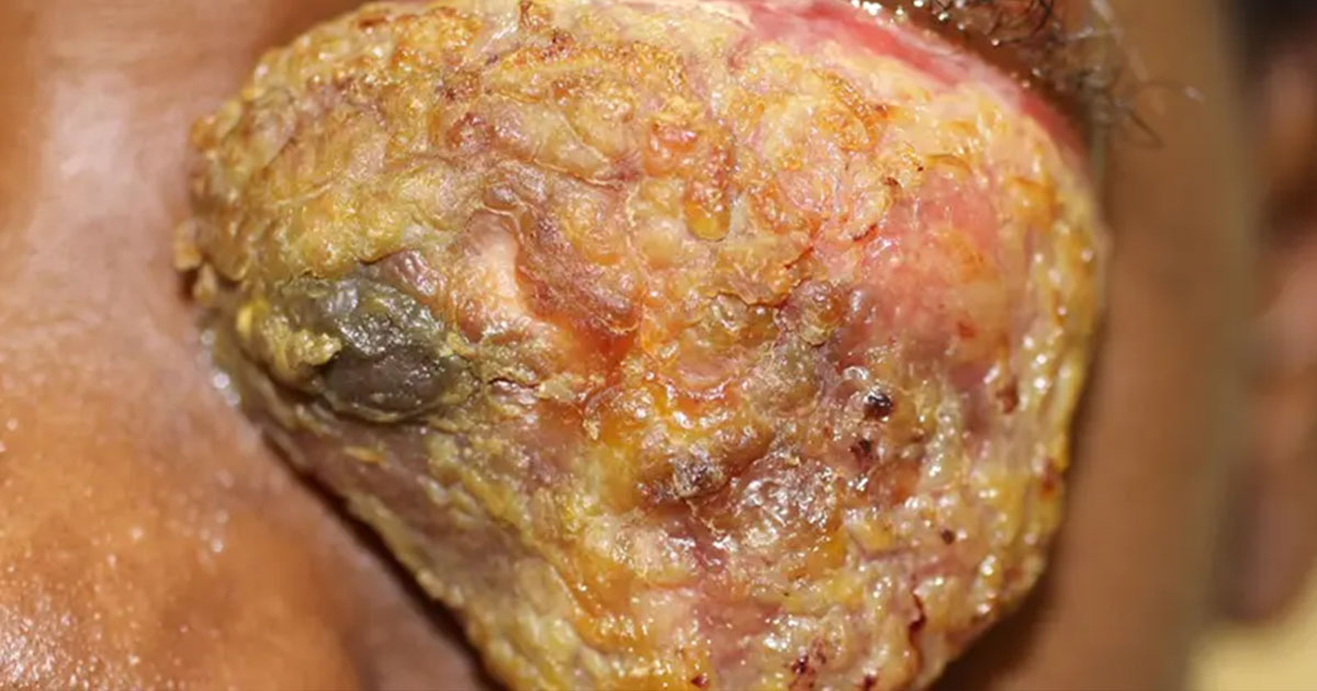 aao_ophth's tweet image. An 11-year-old patient develops a slow-growing mass 2 years after being poked in the #eye. What’s your diagnosis? 

Launch this case to learn the diagnosis and earn self-assessment #CME credit. Free member benefit: ow.ly/niWY50YwzkT

#AAO #Ophthalmology