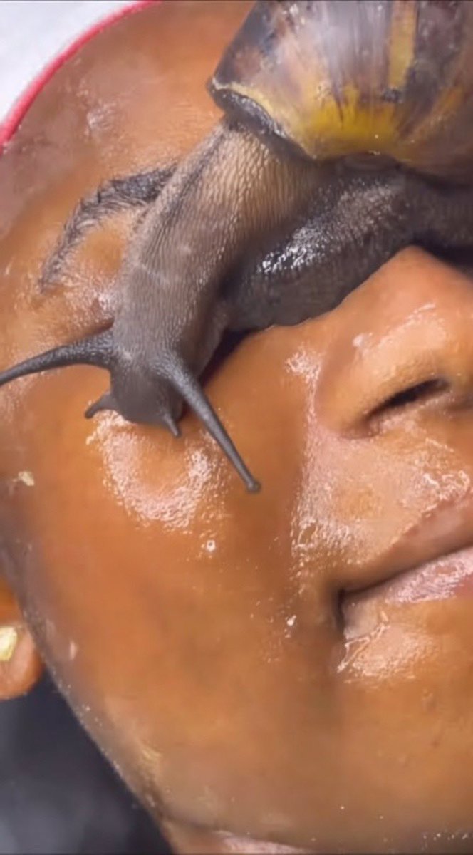 Snail Track Rash A 22-year-old lady presents to your clinic with a chronic, itchy rash ...