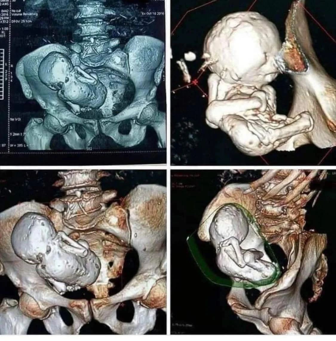 this CT scan belongs to a 73 year old Woman in whom doctors discovered a 30 year old calcified fetus