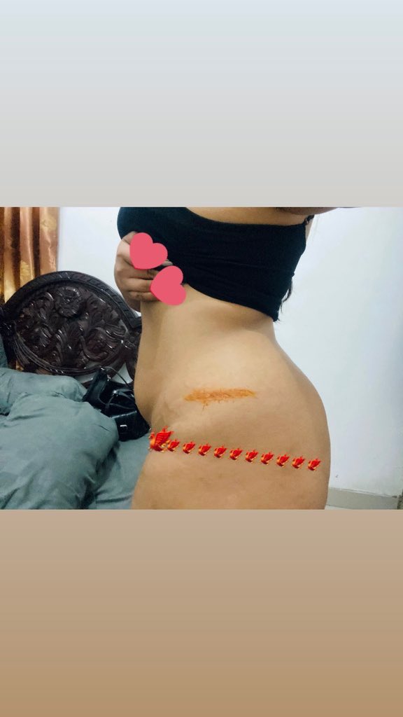 jasminetealemo's tweet photo. sering banget ga sengaja kesandung, kepentok, nubruk 😭 badan pada lebam" 

gausah salfok sama perut bloating please https://t.co/0ouhbBhVpS
