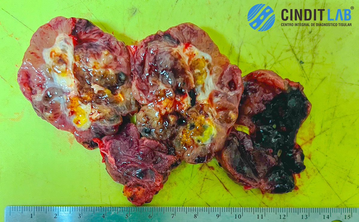 md_castaneda23's tweet photo. Transoperatorio Tiroides
Diagnóstico de bocio multinodular
#cinditlab https://t.co/9GIWbDUaNc