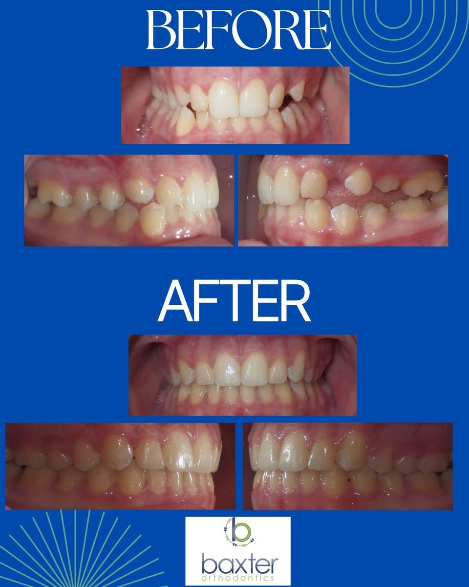 BaxterBraces's tweet photo. 🤩Transformation Tuesday🤩
Check out this beautiful Baxter braces makeover🙌🏼 https://t.co/1WZDoFbuMi