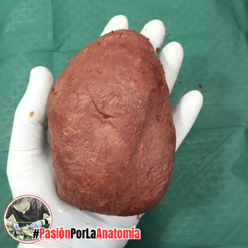 PasionAnatomia's tweet photo. El #bazo está localizado en el hipocondrio izquierdo, detrás del #estómago y sobre la flexura cólica izquierda. Mide unos 11 cm de largo, 7 de ancho y 4 de espesor. https://t.co/RXgwH1NTFR