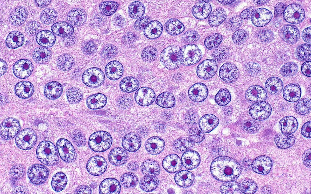 ziad_zaatari's tweet image. 🔬📷 Prostate Cancer Nuclei with Nucleoli...Looking back at you 👀 ~ #GUpath #Pathology #Histology #PathArt