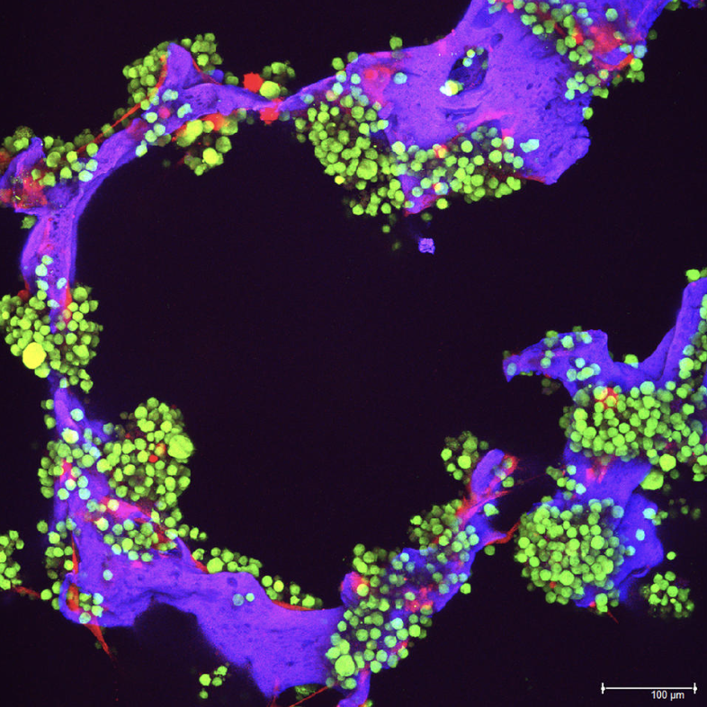 NCIDirector's tweet photo. #MultipleMyeloma can now be managed like a chronic disease in some patients - a remarkable shift. Advances are changing how we treat this disease, and @theNCI-funded research is driving it - improving outcomes and expanding options for people with cancer. https://t.co/5tYzBvIHXp https://t.co/3iYvsYAqSp
