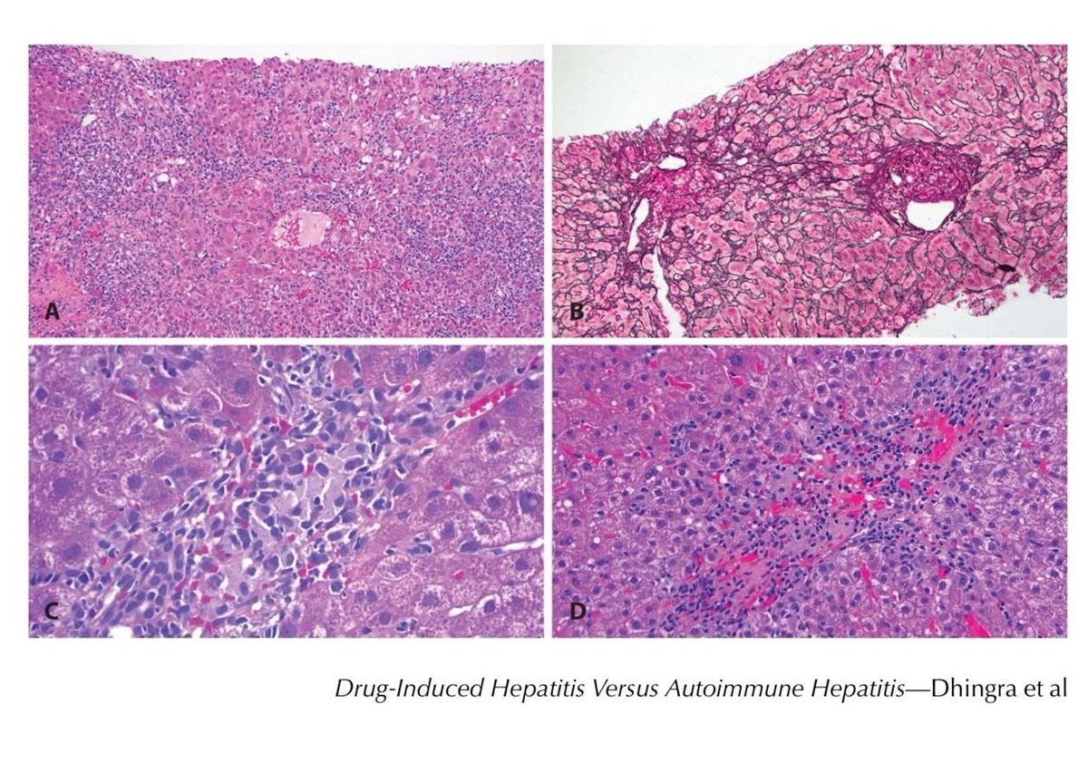 zucchiatti_'s tweet photo. Liver Biopsy Features May Help Distinguish
Drug-Induced Autoimmune-Like Hepatitis From
Idiopathic Autoimmune Hepatitis
https://t.co/8wo067bU9U
#liverpath https://t.co/cK3XlLXtSP