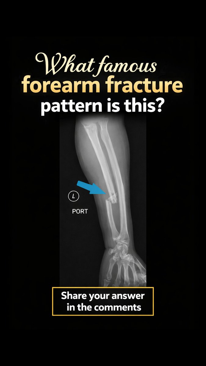 MedEd_Cases's tweet image. Can you identify this classic forearm fracture pattern on X-ray? Take a close look at the ulna and proximal radius—drop your answer in the comments 👇

Find out: tinyurl.com/3upv4693

#orthopedics #radiology #xray #mededucation #sportsmedicine #emergencymedicine #fracture #msk