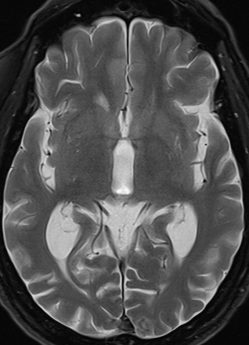 daniel_gewolb's tweet photo. ⭐️ Answer (clinical diagnosis): Corticobasal syndrome

🔷FDG PET showed R>L parietal hypometabolism 

💡 I will share the frontal and temporal lobes given the C9ORF72 expansion (let me know what you think) followed by a general overview of corticobasal degeneration in 🧵👇 

🔷IMO: Symmetric temporal lobe atrophy and perhaps caudate nuclei but frontal lobes look normal aside from the motor cortex