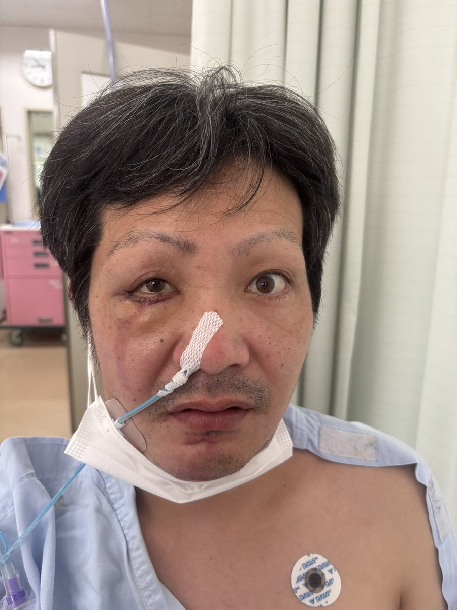 cikun_RYOMA's tweet photo. 作業事故で死にかけました

左側頭部急性硬膜下血腫
多発顔面骨折
左後頭部外傷性くも膜下出血
脳挫傷
右眼瞼裂傷・挫滅
下顎開放創
仙骨骨折
だったようです
前後3週間ぐらい記憶がないです!
意識が戻ったのは2月の中旬 https://t.co/KuyNToXwjv
