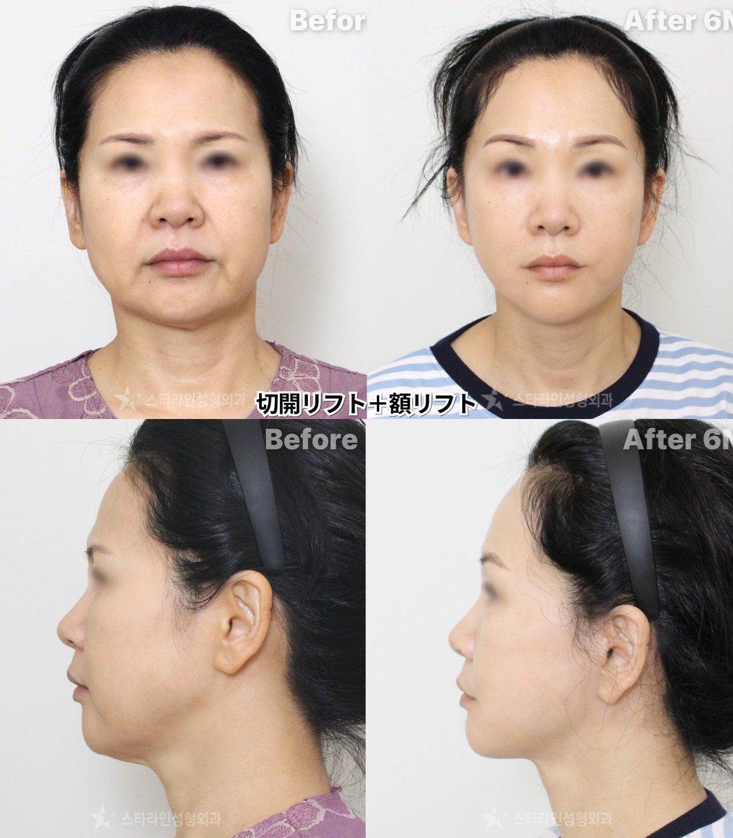 【切開リフト・脂肪吸引専門】 スターライン美容外科 tweet media