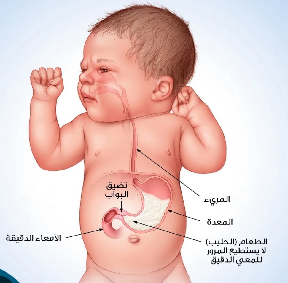 SonoClubsa's tweet photo. تذكر قياسات حالات تضيق مخرج المعدة أو تضيق البواب باستخدام π (3.1415) 🤔 💭 

- سمك الغشاء المخاطي < 3 مم  
- القطر العرضي < 14 مم  
- يجب أن يكون طول القناة < 15 مم  

تذكر علامة ال π  في قياساتك 📏📐 

عند تشخيص حالات تضييق مخرج المعدة 🙏🏻👍🏻✨
#Sonoclubeb #SonoClub https://t.co/PapUeUhK0M