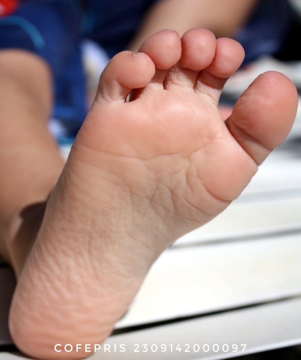 imederm's tweet photo. Como el melanoma en México es mas común en los pies. Todo Lunar en la planta de los puedes debe ser revisado por tú dermatólogo. https://t.co/NbHTPIw7Qz