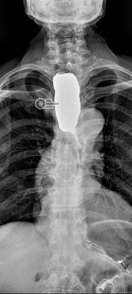 albertoortegana's tweet image. 75/M
C/C: Dysphagia, vomiting after meal
#doctor
#Radiology
#MedicalImaging 
@dr_manish_ydv @Dr_Shiv_kumar_ @DrMedica_13 @drobiy12 @shakilED