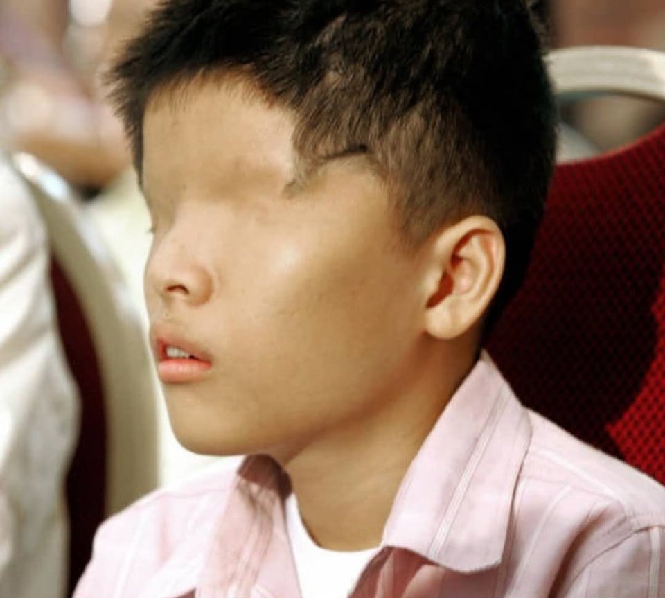 AliciaJ86958882's tweet photo. Este es Le Van O. Un niño vietnamita que nació sin ojos como resultado del " Agente Naranja", un herbicida tóxico que los gringos asesinos rociaron en todo Vietnam entre 1961 y 1971. https://t.co/YiCJNymtgf