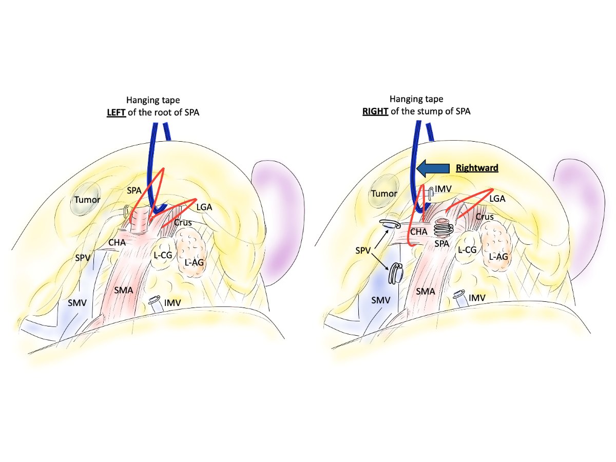 jses_eng's tweet photo. JSES IllustCon 114
📌Left-to-right stepwise hanging technique during LDP
📝During left-posterior approach in LDP, left-to-right stepwise hanging technique facilitates division of SPA and subsequent lymph node dissection around CHA.
🖊Yosuke Kasai
#JSESイラストコンテスト　#JSES_illustration_contest