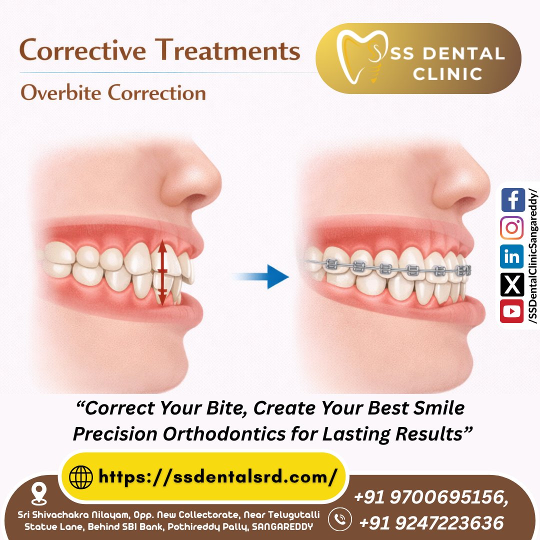 SSDentalClinics's tweet image. #OverbiteCorrection #Orthodontics #StraightTeeth #Sangareddy #SSDentalClinic #SmileCorrection #SangareddyDentist #BiteCorrection #BracesJourney #ClearAligners #DrShivaRamaKrishna #DrShivaratna #PothireddyPally #DentalAlignment #HealthySmile #SangareddyDistrict #ExpertDentist