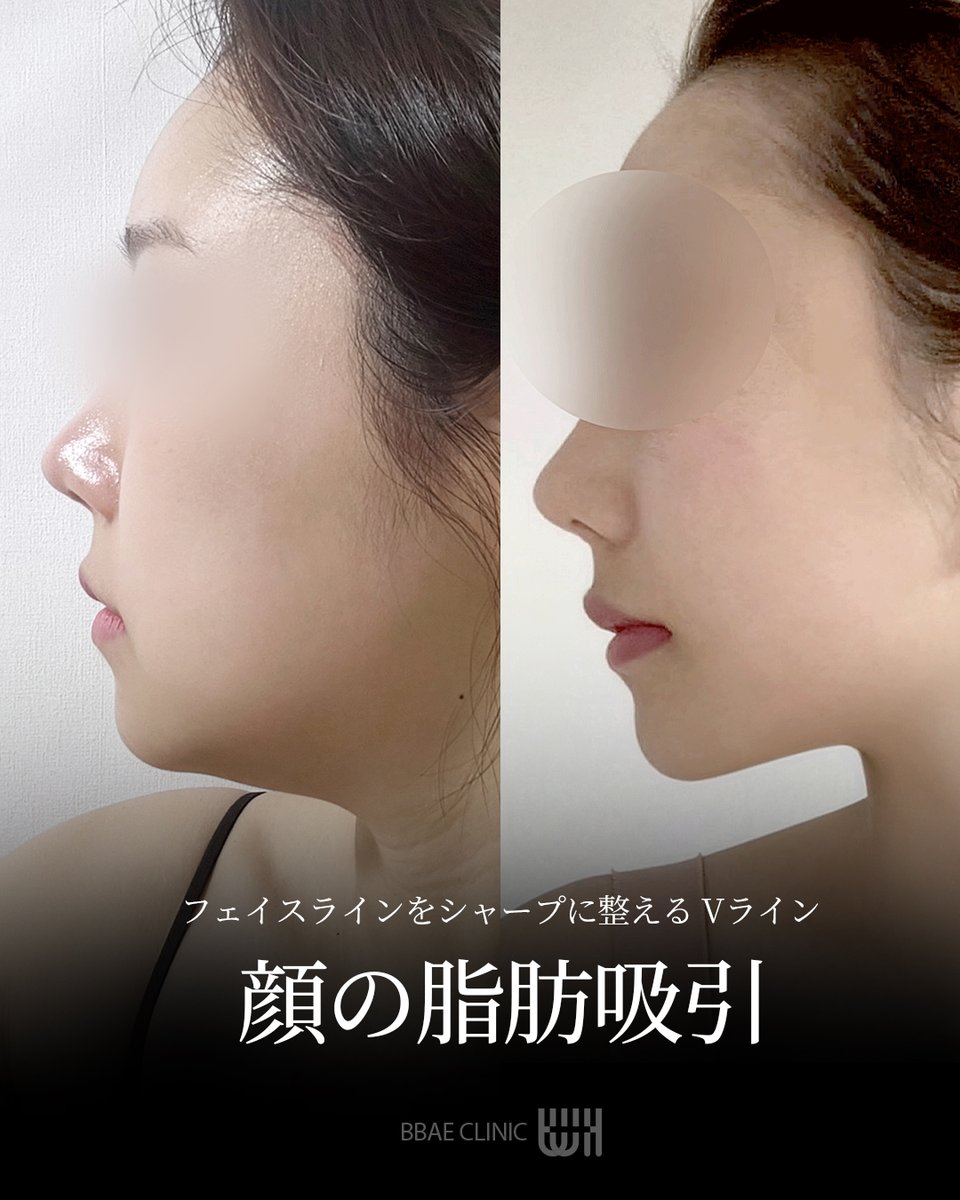 BBAE CLINIC | ポムナゲ・ペー ♥ 韓国脂肪吸引 tweet media