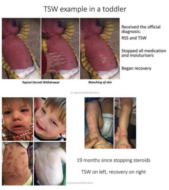 topicaldebate's tweet photo. @drraja_ This story about the mum shows how seriously medicine treats a hormone/HPA‑axis crisis.  
Yet for people with #TSW — same collapse — it’s dismissed as “worse eczema.”  
Steroid over‑prescribing created this. Examine your prescribing, not their sanity.
#SkinHealth #MentalHealth https://t.co/VzRTKQtc5J