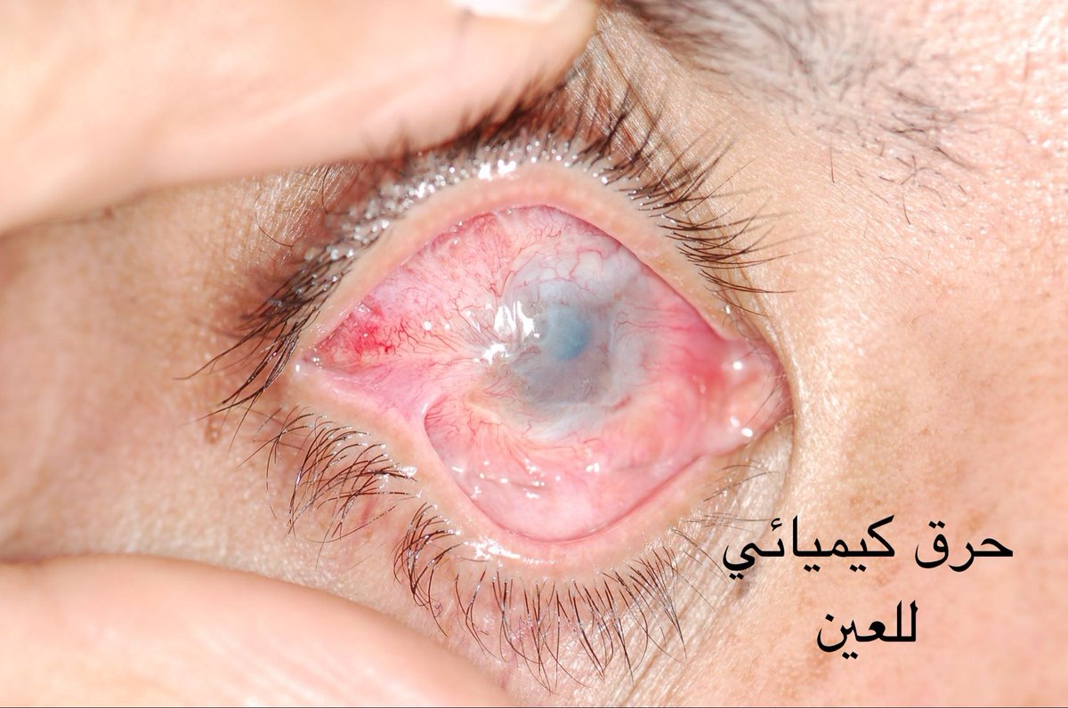 SMBSAMS's tweet photo. @mm36996 الفلاش ماده حارقه للعين
تسبب حروق كيميائية للعين
وتسبب تلف دائم للملتحمه والقرنيه وجلكوما ومن ثم ضعف شديد بالنظر اذا استخدم بدون حمايه

اقترح على صاحب المقطع وصاحب الحساب حذفه 
…. نصيحه 
الحفاظ على العين اولى من نظافة الشكمان

@KKESHKSA 

@SaudiMOH https://t.co/yS49ORsr02