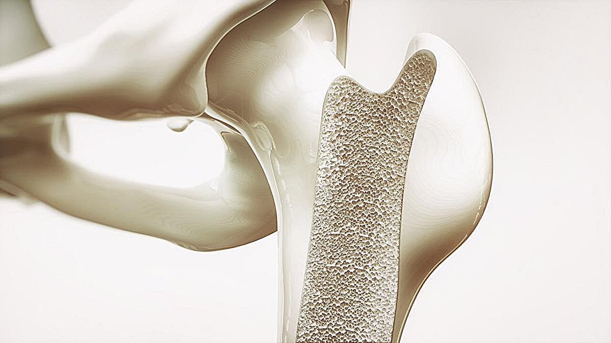 talius's tweet photo. AAOS: #GLP-1 #receptor #agonist use #increases 5-yr risk for #osteoporosis
Glucagon-like peptide-1 receptor agonists for type 2 diabetes & obesity are independently associated with a significantly increased five-year risk for OP, #gout, #osteomalacia https://t.co/gG4VldnaCS https://t.co/q4R596M0QN