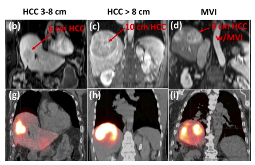 J__Huang's tweet photo. A novel lung shunt fraction (LSF) metric can reliably identify 90Y-SIRT cases where MAA-based LSF determination may be omitted while preserving treatment planning accuracy.

@RSNA @OxfordJournals @SusannaLeeRad
https://t.co/7etT4OSlSC https://t.co/mF5jYQ7qHO