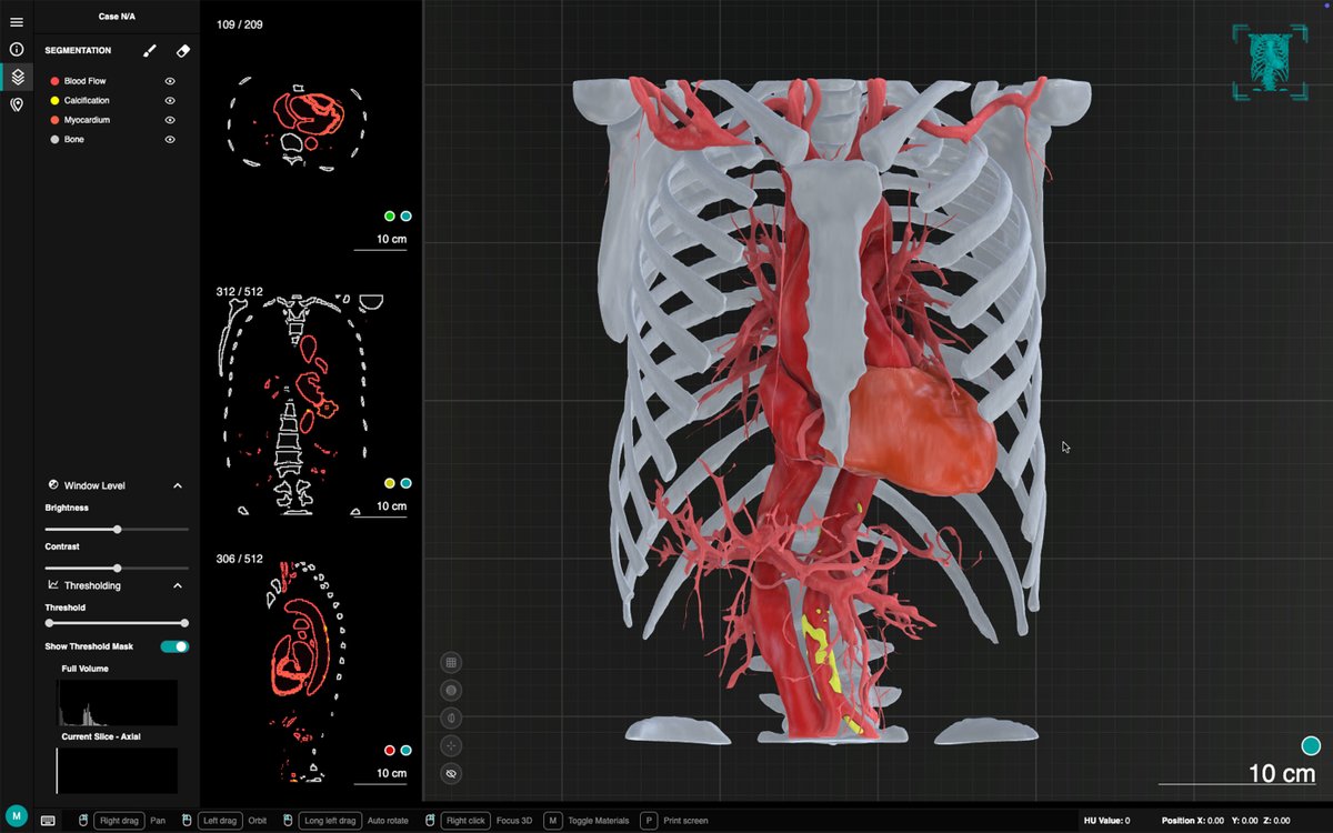 Axial_3D's tweet image. Automated segmentation delivers consistency, reduces variability, and enables confident surgical planning at scale.

Powering PSI, robotics, and navigation to improve outcomes, one patient at a time.

#MedTech #MedicalDevices #3DData #SurgicalPlanning #PatientSpecific