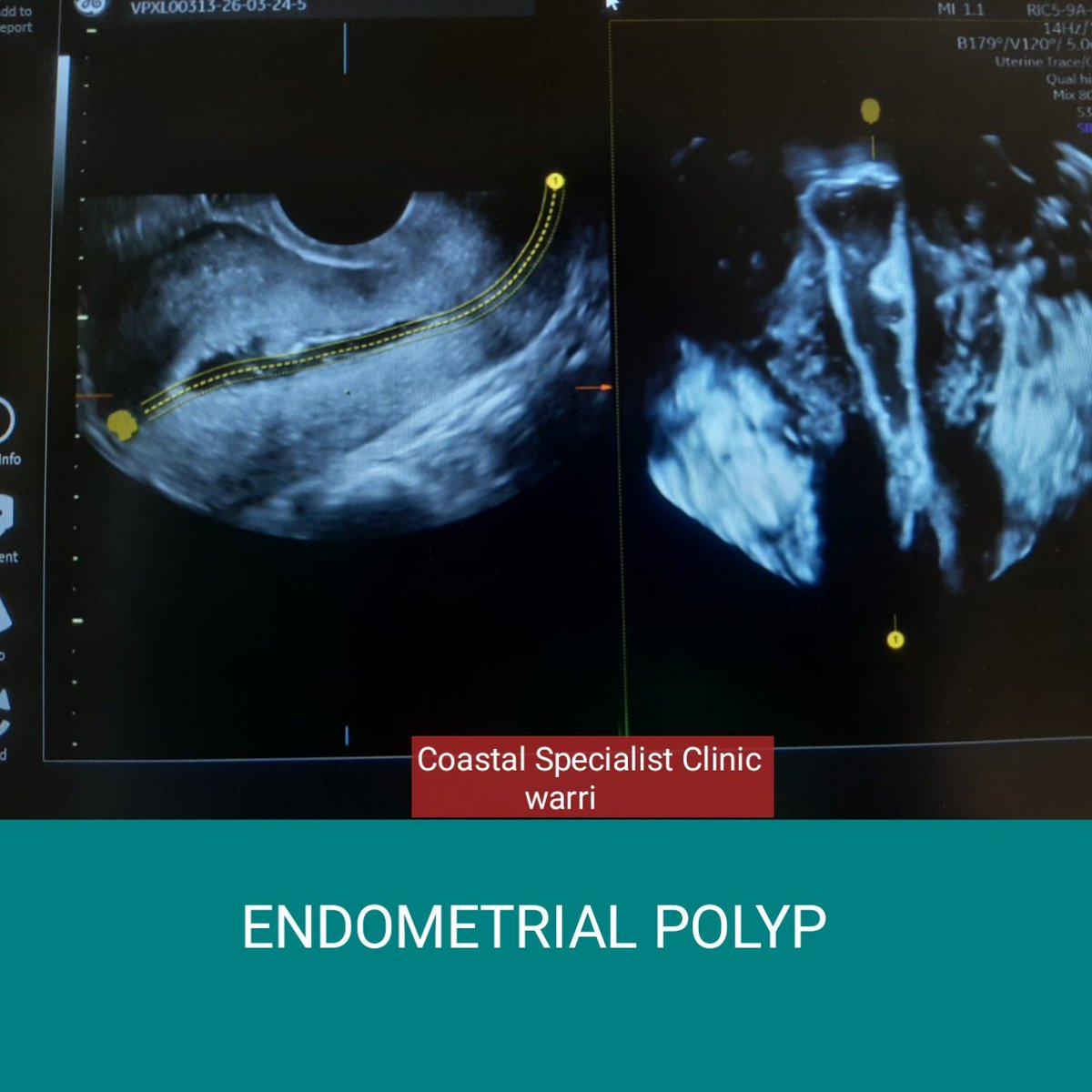 Saline infusion sonography 
Endometrial polyp was demonstrated on infusion of contrast.