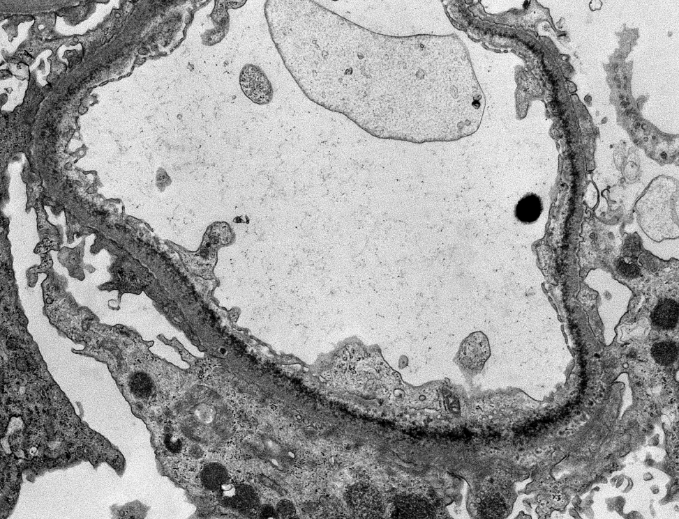 JZRenalPath's tweet photo. Classic powdery electron dense deposits along GBMs, TBMS, and in vascular walls by EM in this case of light chain deposition disease. #renalpath #pathtwitter #nephrology https://t.co/yhIxqH6BVh