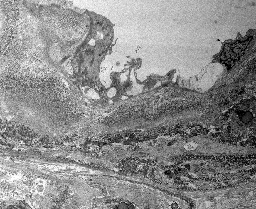 JZRenalPath's tweet photo. Classic powdery electron dense deposits along GBMs, TBMS, and in vascular walls by EM in this case of light chain deposition disease. #renalpath #pathtwitter #nephrology https://t.co/yhIxqH6BVh