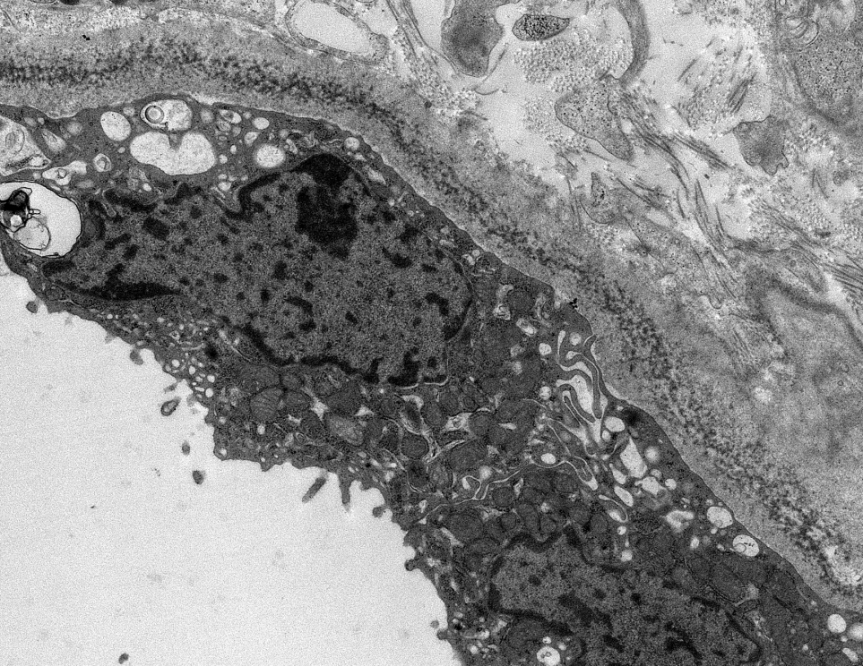 JZRenalPath's tweet photo. Classic powdery electron dense deposits along GBMs, TBMS, and in vascular walls by EM in this case of light chain deposition disease. #renalpath #pathtwitter #nephrology https://t.co/yhIxqH6BVh