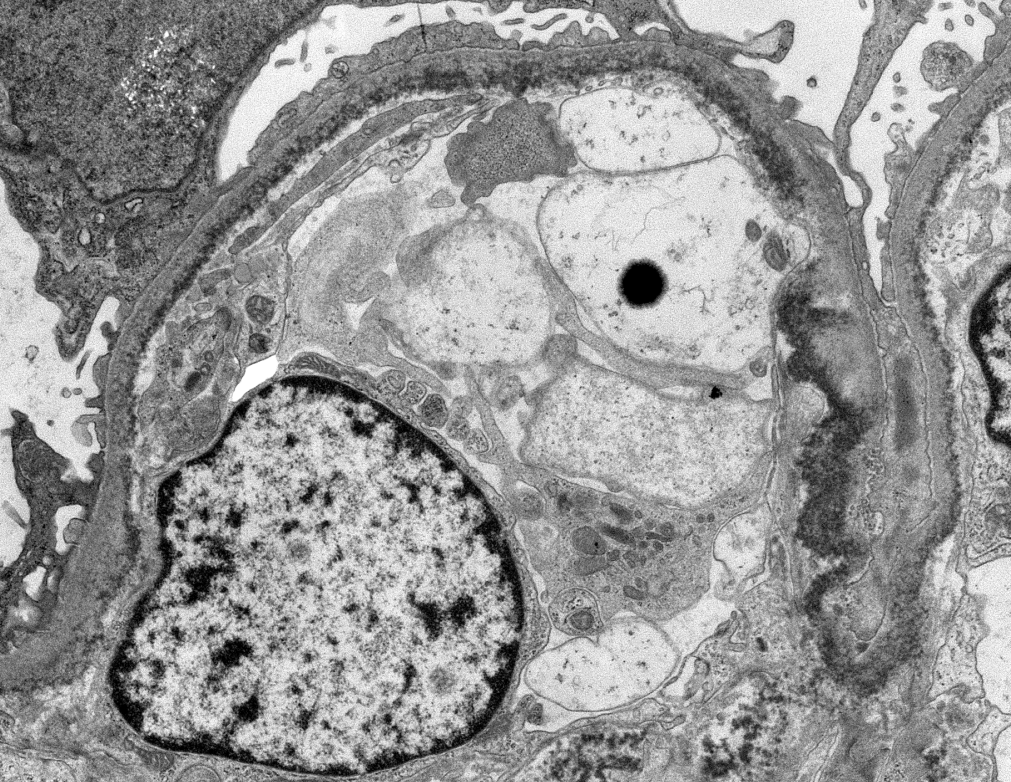JZRenalPath's tweet photo. Classic powdery electron dense deposits along GBMs, TBMS, and in vascular walls by EM in this case of light chain deposition disease. #renalpath #pathtwitter #nephrology https://t.co/yhIxqH6BVh