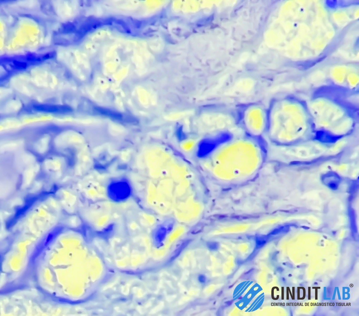 md_castaneda23's tweet image. Bacilos de Koch 
Mycobacterium Tuberculosis 

#pathologylab #cinditlab